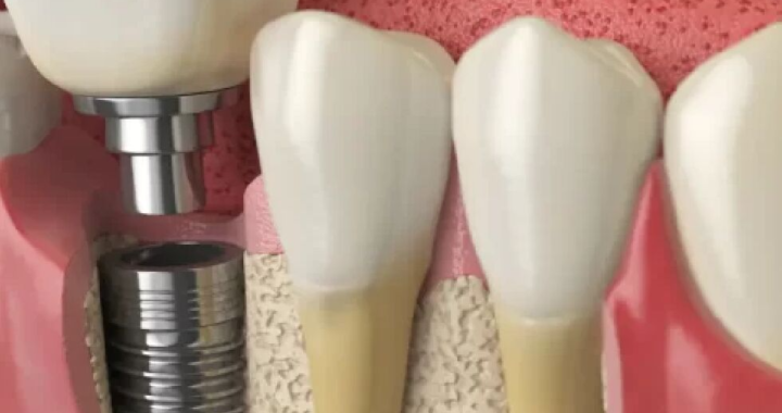 The Cost Of Dental Implants And What To Expect