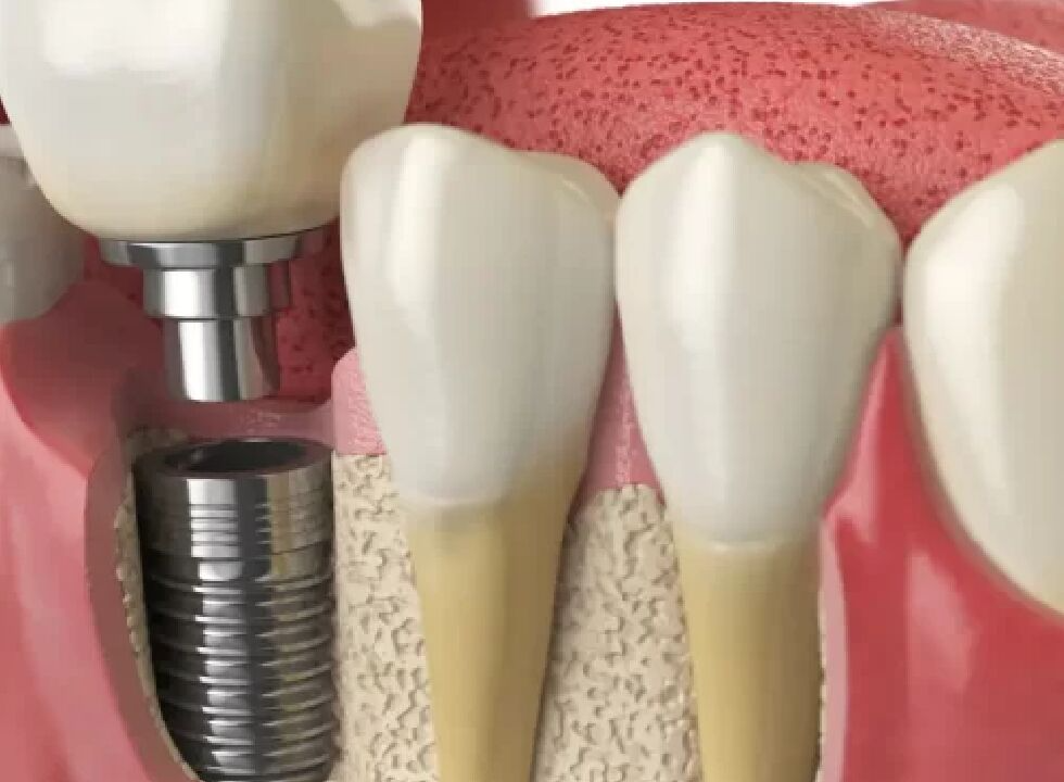 The Cost Of Dental Implants And What To Expect